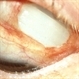 Scleral buckle, exposed Scleral buckle, exposed